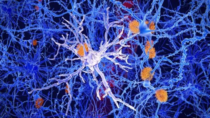A Network of Neurons with Amyloid Plaques(AD)